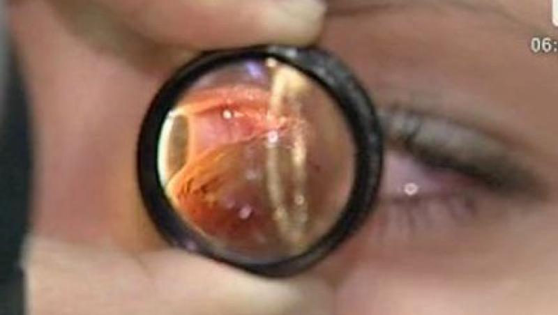 VIDEO! Ochii uscati - o boala cauzata de aerul conditionat