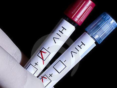 SIDA ar putea fi invinsa! Noua terapie pentru anihilarea virsului HIV