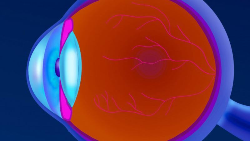 Prima retina artificiala ajunge in Europa
