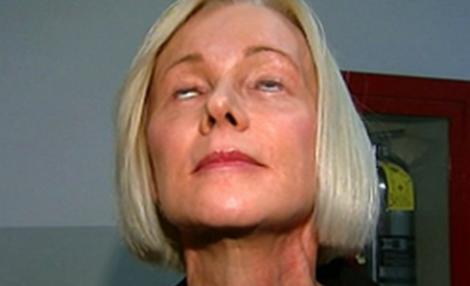 O femeie nu mai poate sa isi inchida ochii din cauza unei operatii de intinerire