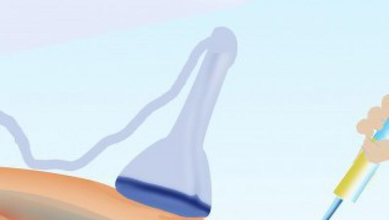 Sindromul Down, depistat cu un simplu test de sange