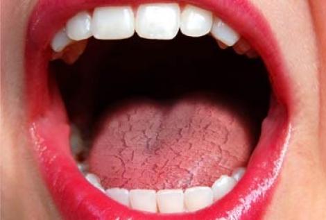 VIDEO! Xerostomia - sindromul gurii uscate