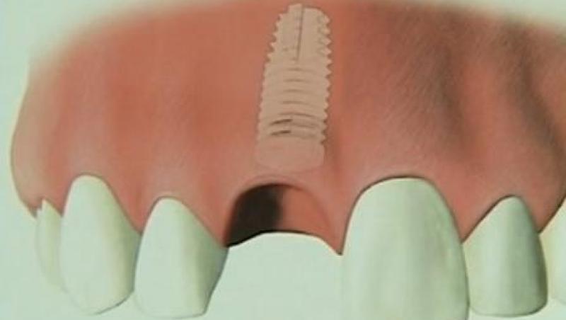 VIDEO! Implantul dentar - calea catre un zambet perfect