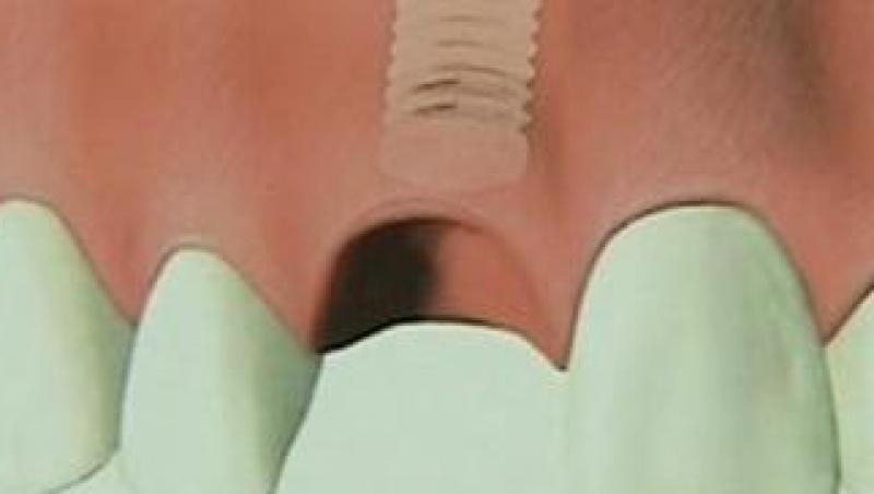 VIDEO! Implantul dentar - calea catre un zambet perfect