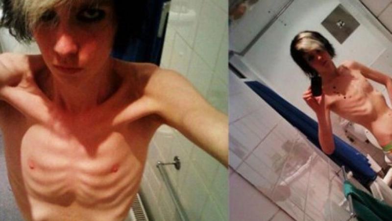 Povestea unui anorexic: 