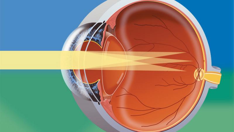 VIDEO! Afla ce este si cum poate fi tratat astigmatismul!