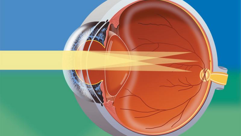 VIDEO! Afla ce este si cum poate fi tratat astigmatismul!