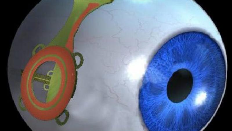 VIDEO! Ochiul bionic - o raza de lumina pentru nevazatori