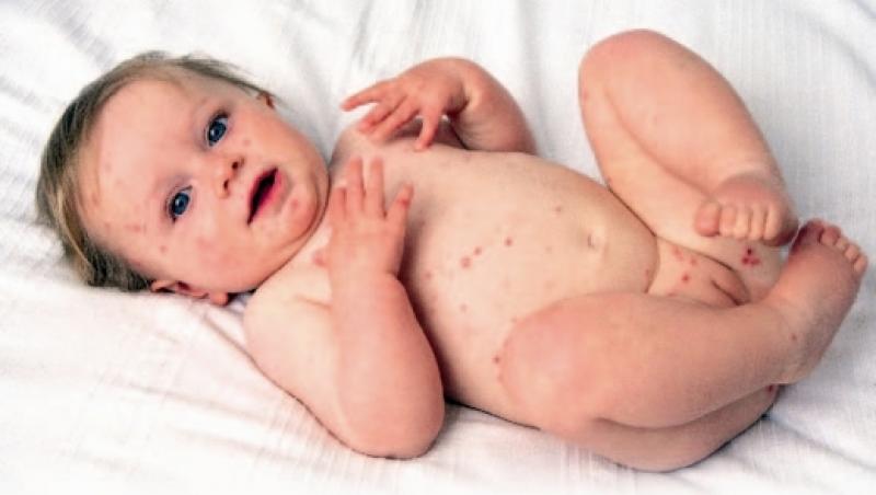 Rujeola - boala contagioasa a copilariei