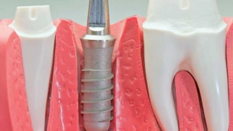 Dinti frumosi cu punte dentara sau implant dentar