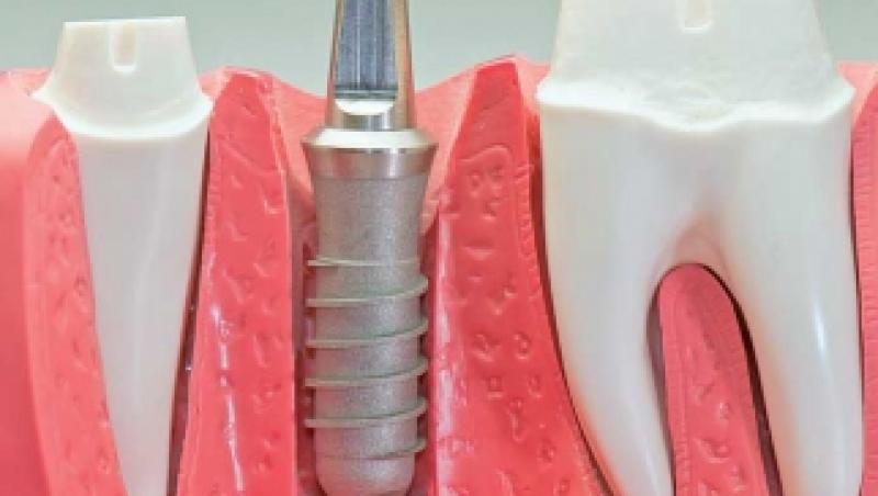 Dinti frumosi cu punte dentara sau implant dentar