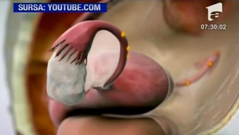 VIDEO! Endometrioza poate duce la infertilitate