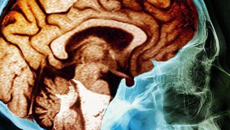 Creierul se micsoreaza ca urmare a pierderii materiei cenusii