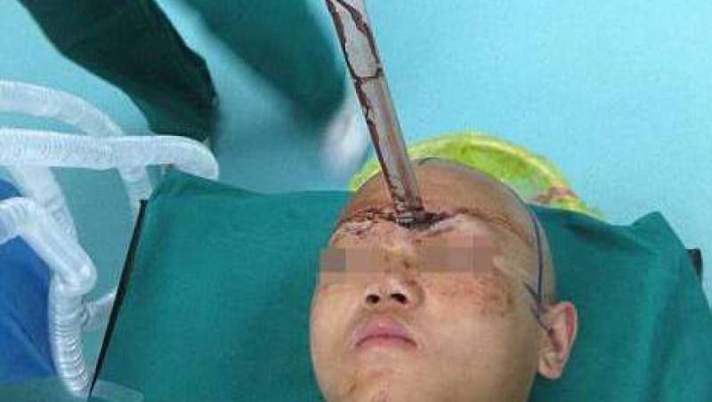 China: Un adolescent a scapat teafar dupa ce o sabie i-a intrat in cap 5 centimetri