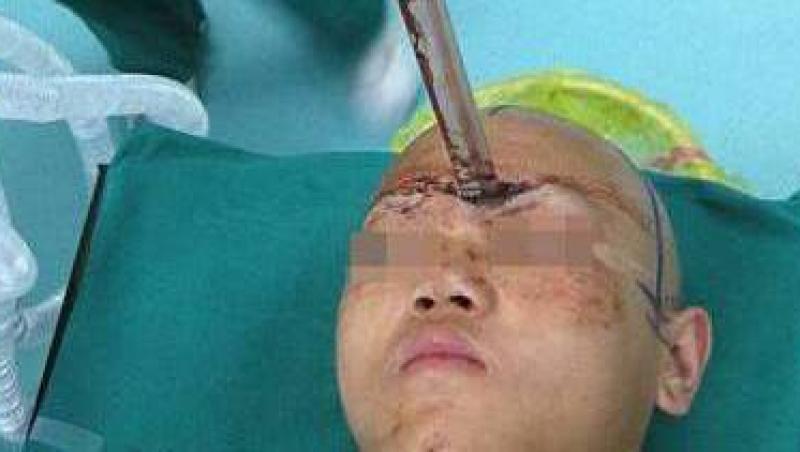China: Un adolescent a scapat teafar dupa ce o sabie i-a intrat in cap 5 centimetri
