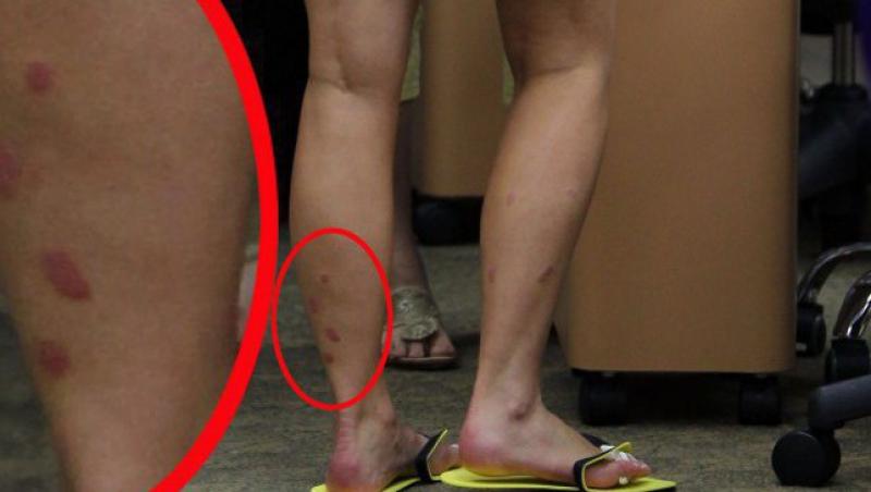 FOTO! Kim Kardashian, cu picioarele distruse de psoriazis!