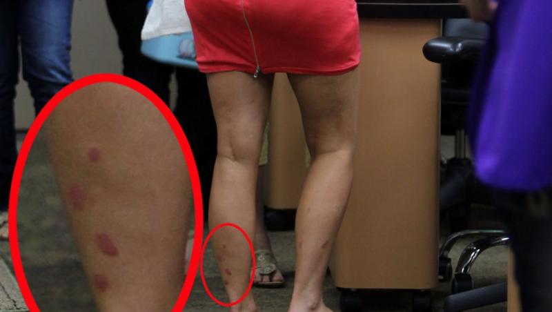 FOTO! Kim Kardashian, cu picioarele distruse de psoriazis!