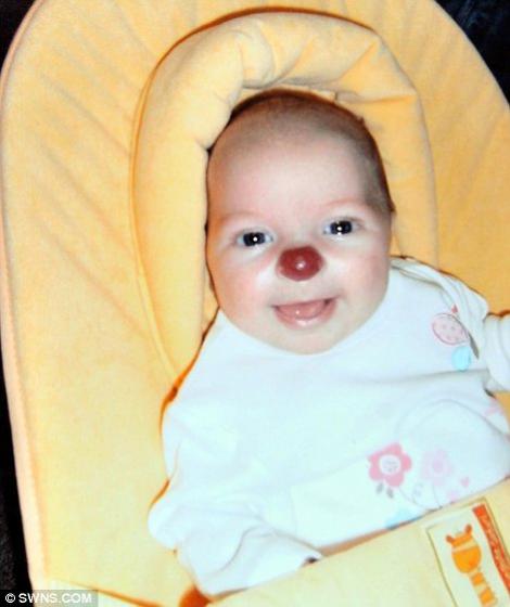 Marea Britanie: O fetita s-a nascut cu sindromul "nas de clovn"