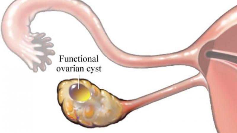 Ce trebuie sa stii despre chistul ovarian