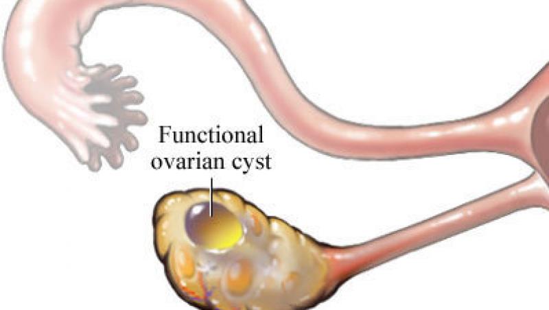 Ce trebuie sa stii despre chistul ovarian
