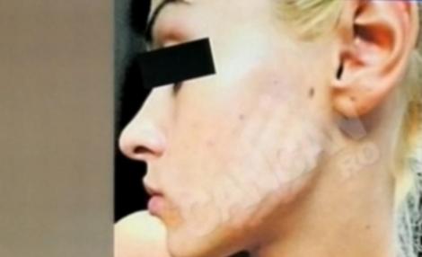 Socant! Tanara mutilata la cosmetica, din cauza unui tratament anti-acnee