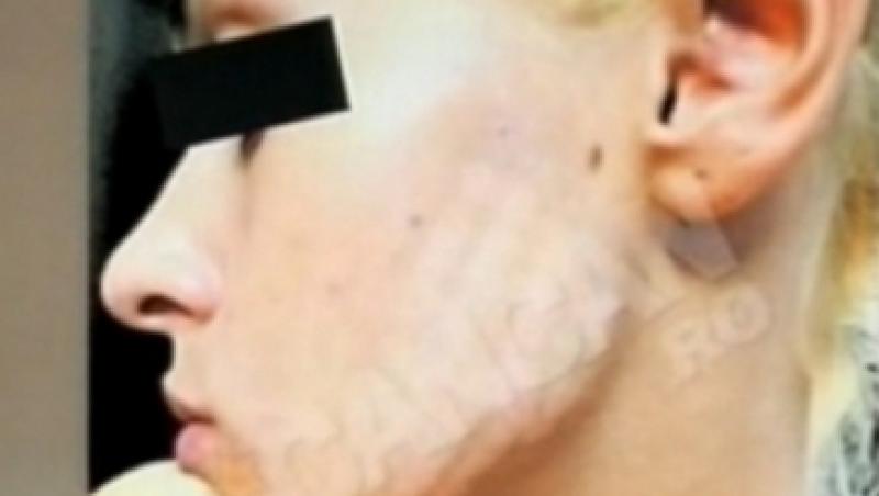 Socant! Tanara mutilata la cosmetica, din cauza unui tratament anti-acnee
