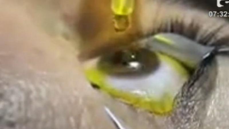 VIDEO! Keratoconul, boala tacuta a ochiului