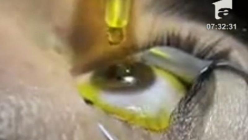 VIDEO! Keratoconul, boala tacuta a ochiului