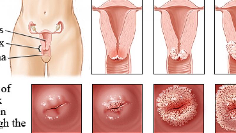VIDEO! Afla mai multe despre cancerul de col uterin!