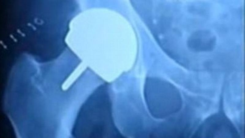 Operatiile cu implanturi din metal sunt periculoase pentru organism!