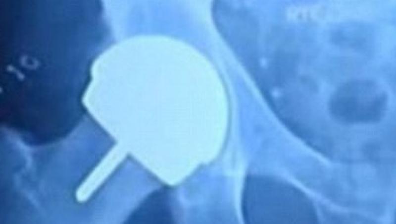 Operatiile cu implanturi din metal sunt periculoase pentru organism!