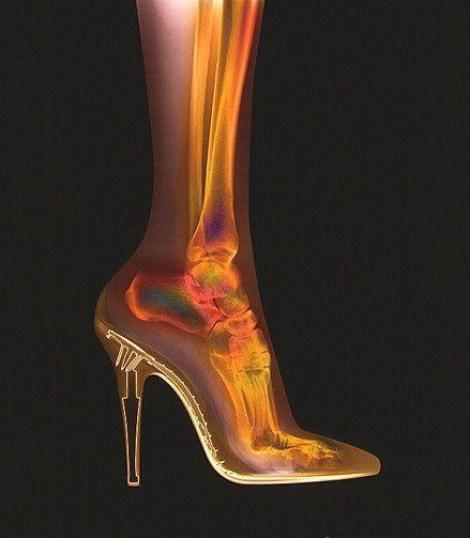 FOTO! Vezi cum arata radiografia piciorului cand porti tocuri!
