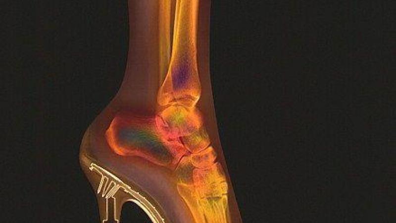 FOTO! Vezi cum arata radiografia piciorului cand porti tocuri!