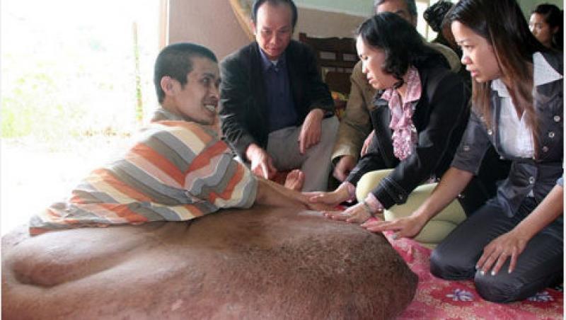 Vietnam: Un barbat va fi operat de o tumora de 90 de kilograme!