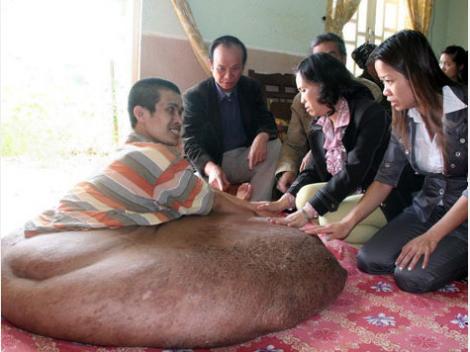 Vietnam: Un barbat va fi operat de o tumora de 90 de kilograme!