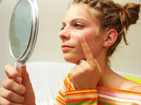 Cele mai frecvente cauze ale aparitiei acneei