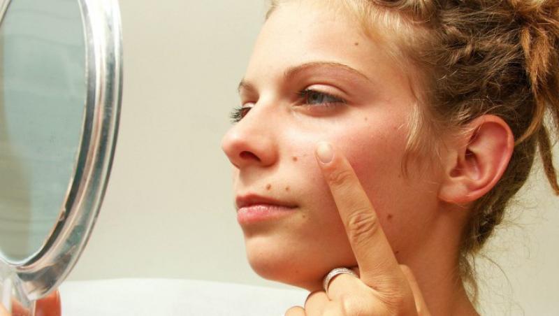 Cele mai frecvente cauze ale aparitiei acneei