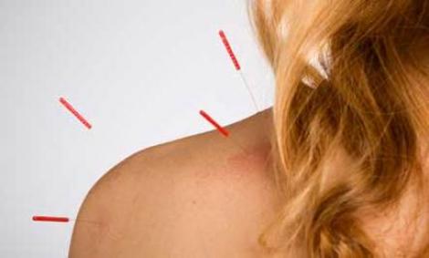 Acupunctura - 40% mai multe sanse pentru a ramane insarcinata