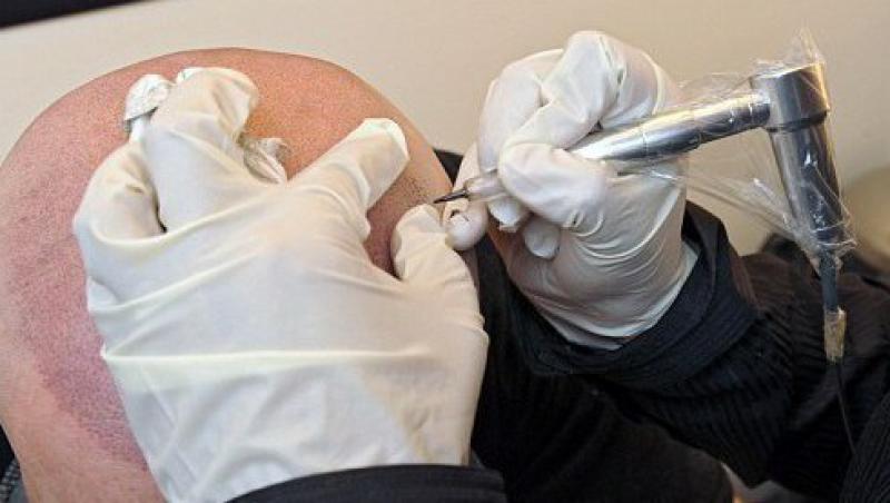 Tatuarea scalpului, noua metoda de a ascunde chelia la barbati