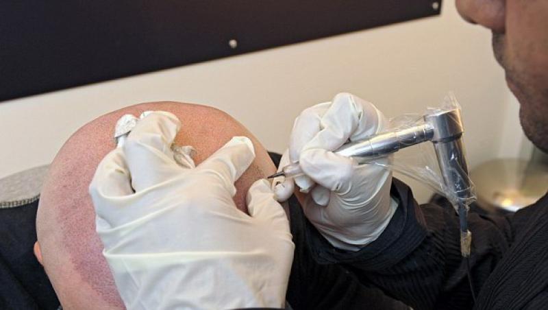 Tatuarea scalpului, noua metoda de a ascunde chelia la barbati
