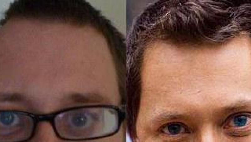 Marea Britanie: Barbatul cu jumatate de scalp lipsa este din nou intreg