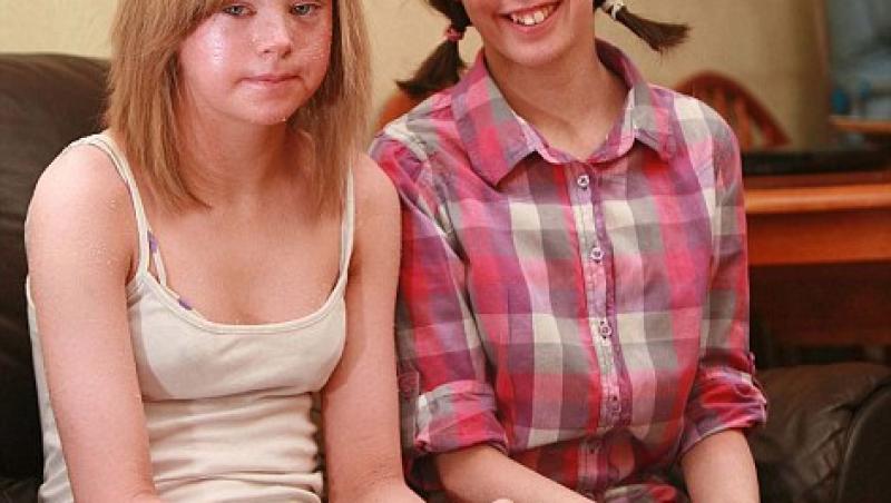 Marea Britanie: Doua surori s-au nascut cu piele de sarpe