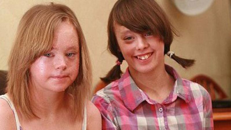 Marea Britanie: Doua surori s-au nascut cu piele de sarpe