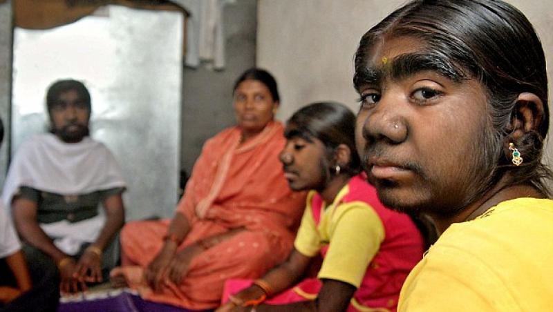 India: Trei surori sufera de Sindromul Varcolacului