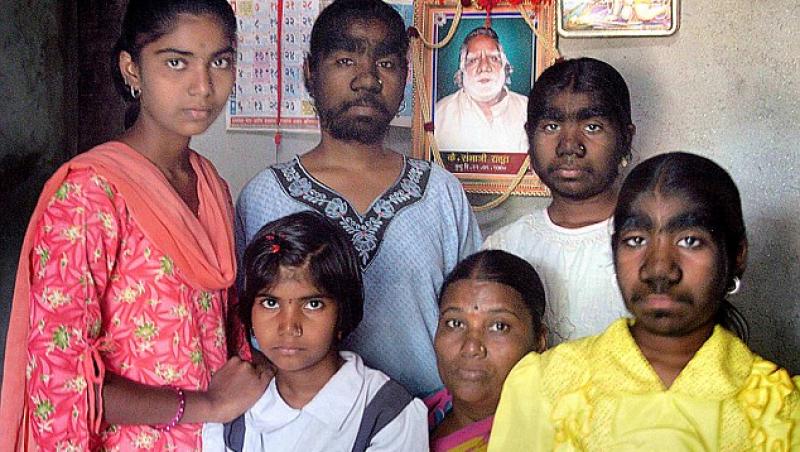 India: Trei surori sufera de Sindromul Varcolacului