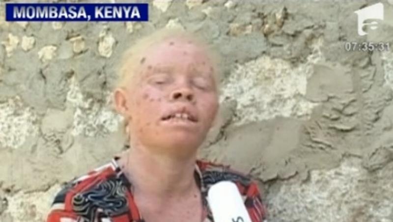 VIDEO! Albinosii, rapiti si ucisi in Africa
