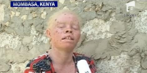 VIDEO! Albinosii, rapiti si ucisi in Africa