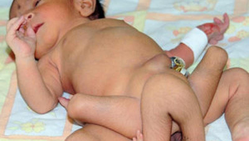 VIDEO! In Pakistan s-a nascut un bebelus cu sase picioare