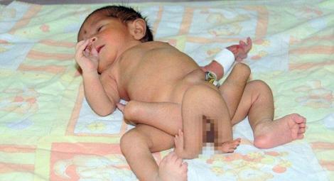 Pakistan: Doctorii au indepartat chirurgical patru din cele sase picioare ale "bebelusului caracatita"