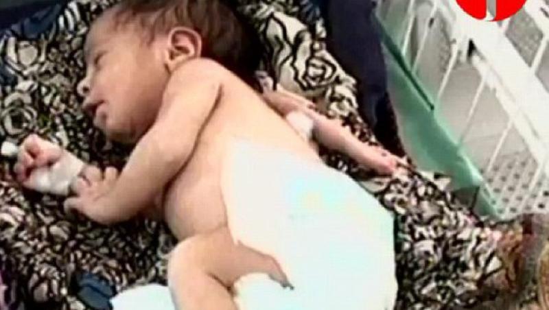 O fetita din Pakistan s-a nascut cu trei brate